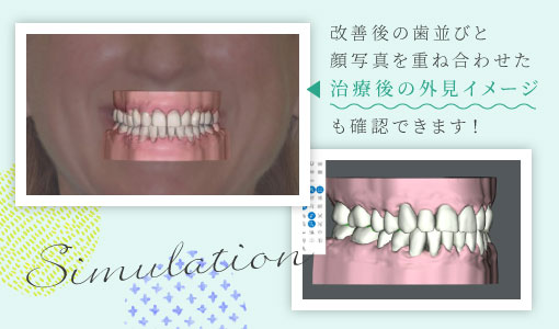 改善後の歯並びと顔写真を重ね合わせた治療後の外見イメージも確認できます！
